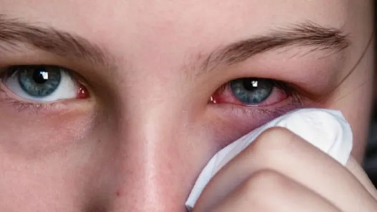 VIRUSNI KONJUKTIVITIS: Iznimno zarazno crvenilo oka koje moe potrajati  mjesec dana - Net.hr