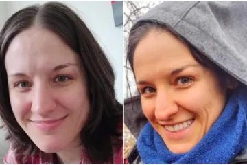 Koža joj poprimila neobičnu boju: 'Simptomi mogu dovesti do pogrešne dijagnoze'