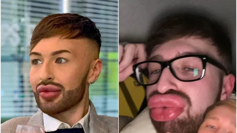 Ovisnost o fileru i botoksu pretvorila ga u patku, a onda je napravio čudo: Sada izgleda kao maneken