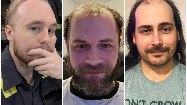 Ćelavite? Postoji divno mjesto na internetu gdje će vam tisuće ljudi pružiti podr&scaron;ku i utjehu