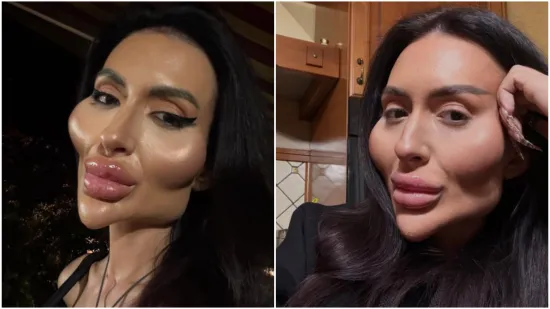 Ponosno nosi titulu žene s najvećim obrazima: Prije je bila prava ljepotica, evo kako je izgledala