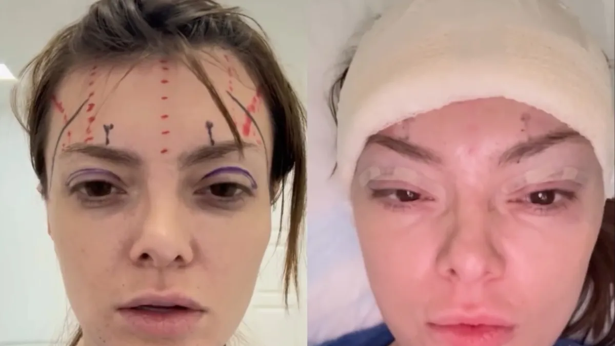 Ella Dvornik o estetskom zahvatu: 'Želim samo otvoreniji, odmorniji pogled' — image 1