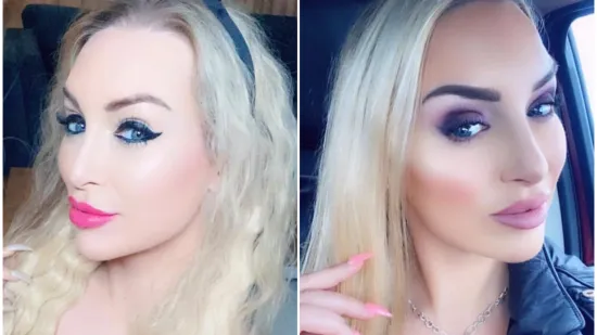 Potro&scaron;ila je bogatstvo da bi bila Barbie: Sada ulaže jo&scaron; vi&scaron;e kako bi vratila prirodan izgled