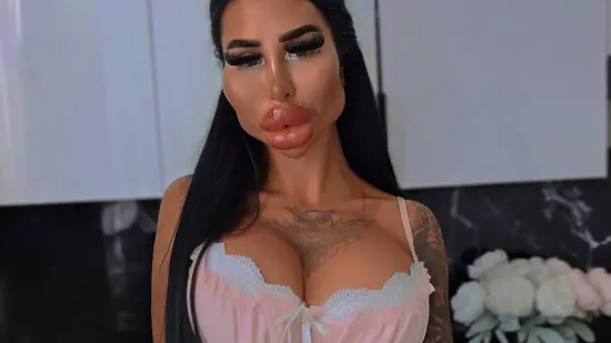Ne, ovo nije Photoshop: Ljubiteljica estetskih zahvata &scaron;okirala fanove svojim izgledom