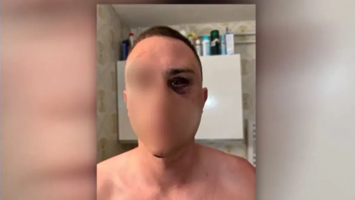 Progovorio pretučeni Slovenac u Medulinu: 'Nakon što sam pao, drugi me je udario'