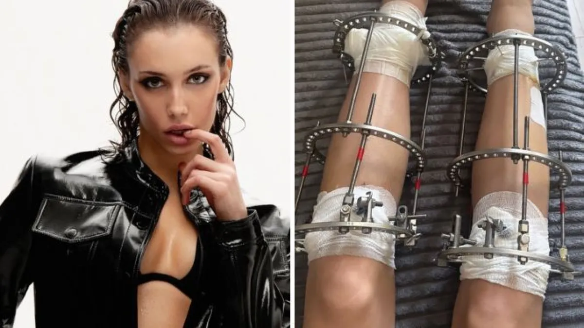 Šokantna odluka modela: Dobrovoljno dala slomiti noge zbog karijere
