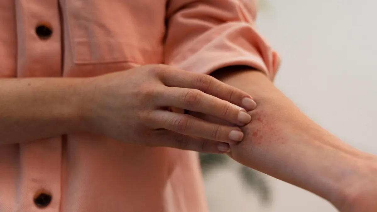 Vrućine utječu na ovu kožnu bolest: Dermatolozi objasnili zašto se simptomi pogoršavaju
